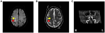 Cerebral infarction in centrum semiovale presenting with hemichorea: a case report and literature review